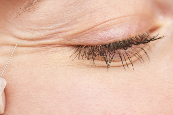 ANTIWRINKLE INJECTIONS in newcastle (1) ANTIWRINKLE INJECTIONS in newcastle (1)