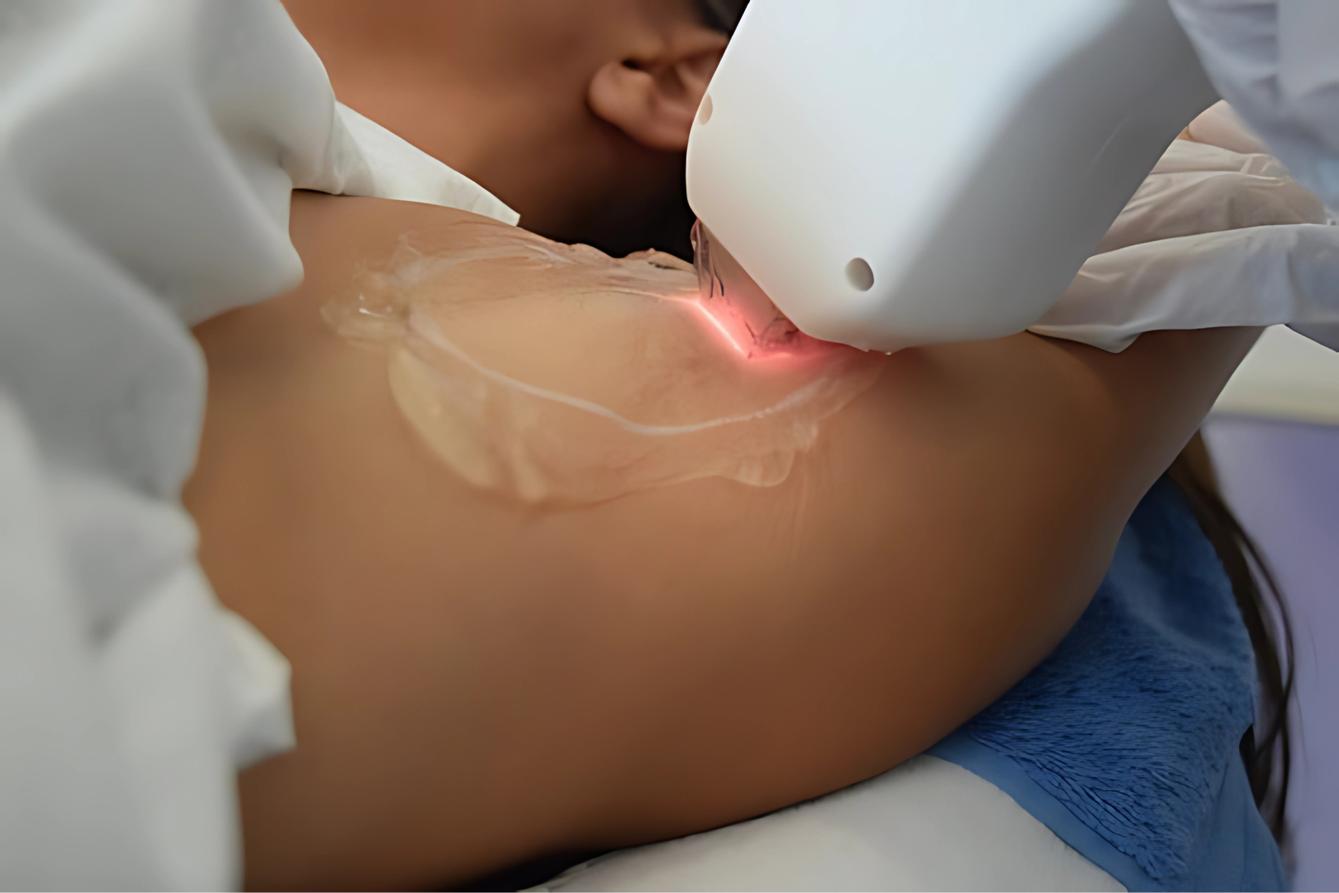 LASER BODY REJUVENATION IN NEWCASTLE