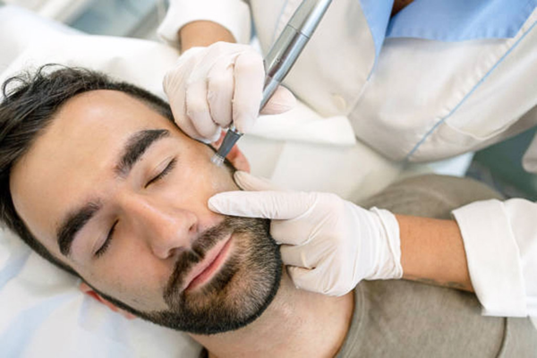 MICRONEEDLING FOR MEN